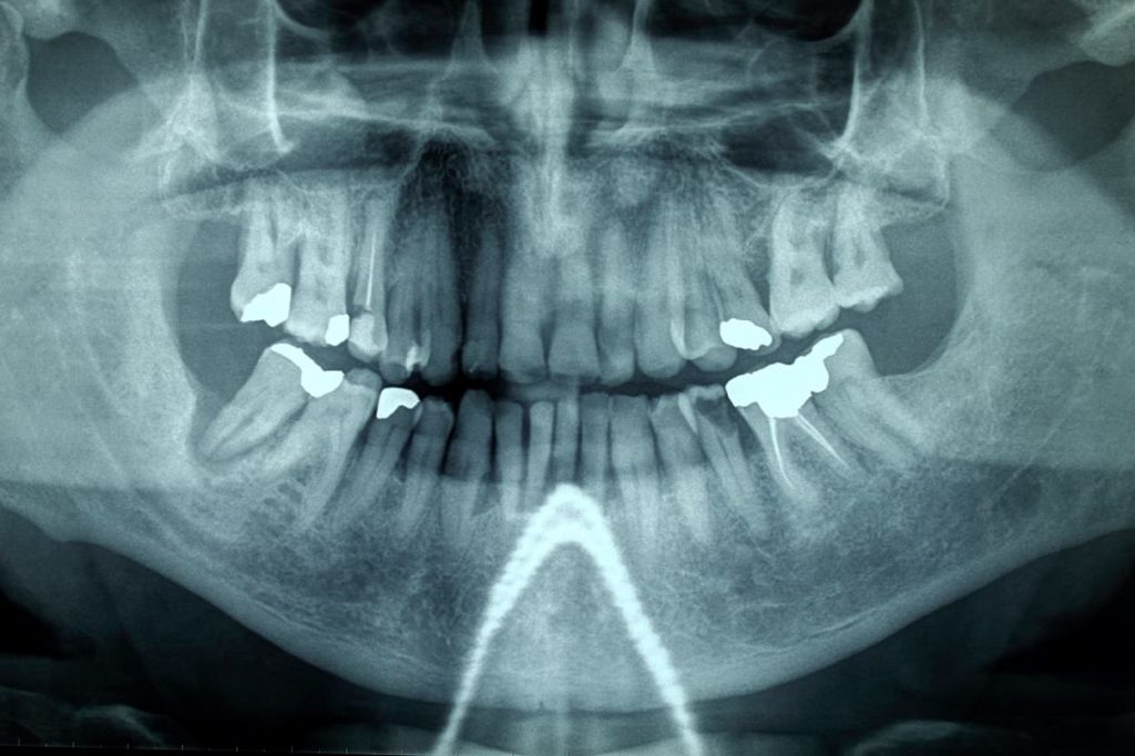 otturazione dente