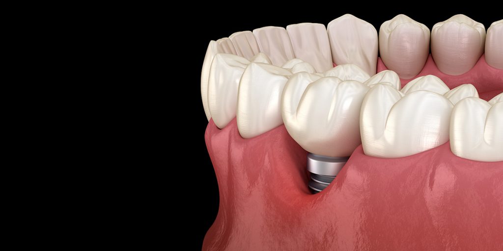 perimplantite