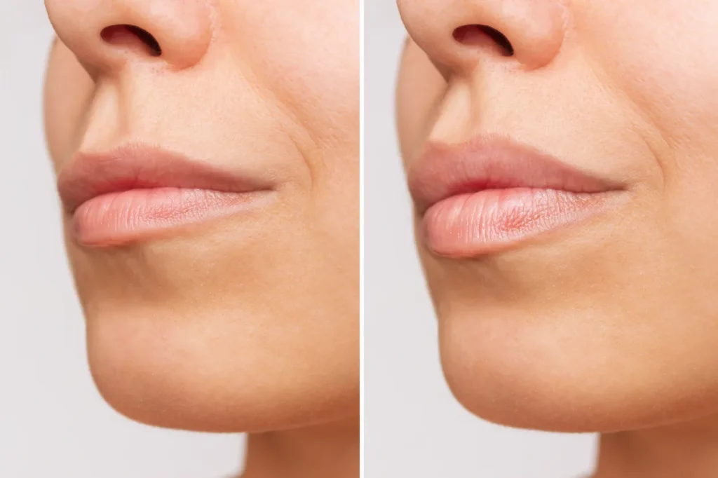 filler labbra naturali